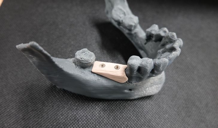 Hybrydowy układ (bioresorbowalny element+implant zębowy) do szybszego, tańszego i bezpieczniejszego leczenia implantologicznego..