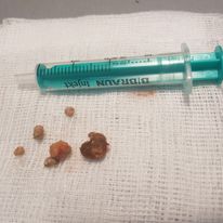 kamienie usunięte z pęcherza moczowego 