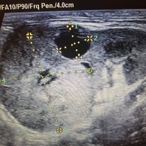 USG bardzo chorej nerki ... 